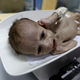 Ali Mohammed al-Tawaari, a six-month-old malnourished boy, cries as he is weighed in a malnutrition intensive care unit in Sanaa, Yemen July 30, 2015. Ali suffers from malnourishment and complications from a botched circumcision performed by an unqualified practitioner. (Reuters/Khaled Abdullah)